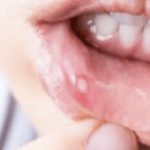 口内炎ができた時の最強の対処法…これならすぐ治ると話題に…