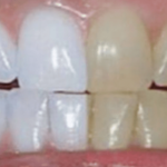 身近なもので歯をホワイトニングする3つの方法…簡単に試せると話題に…
